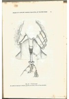 LA PRATIQUE CHIRURGICALE ILLUSTREE Victor Pauchet 1930 Doin fasc, XVI fractures